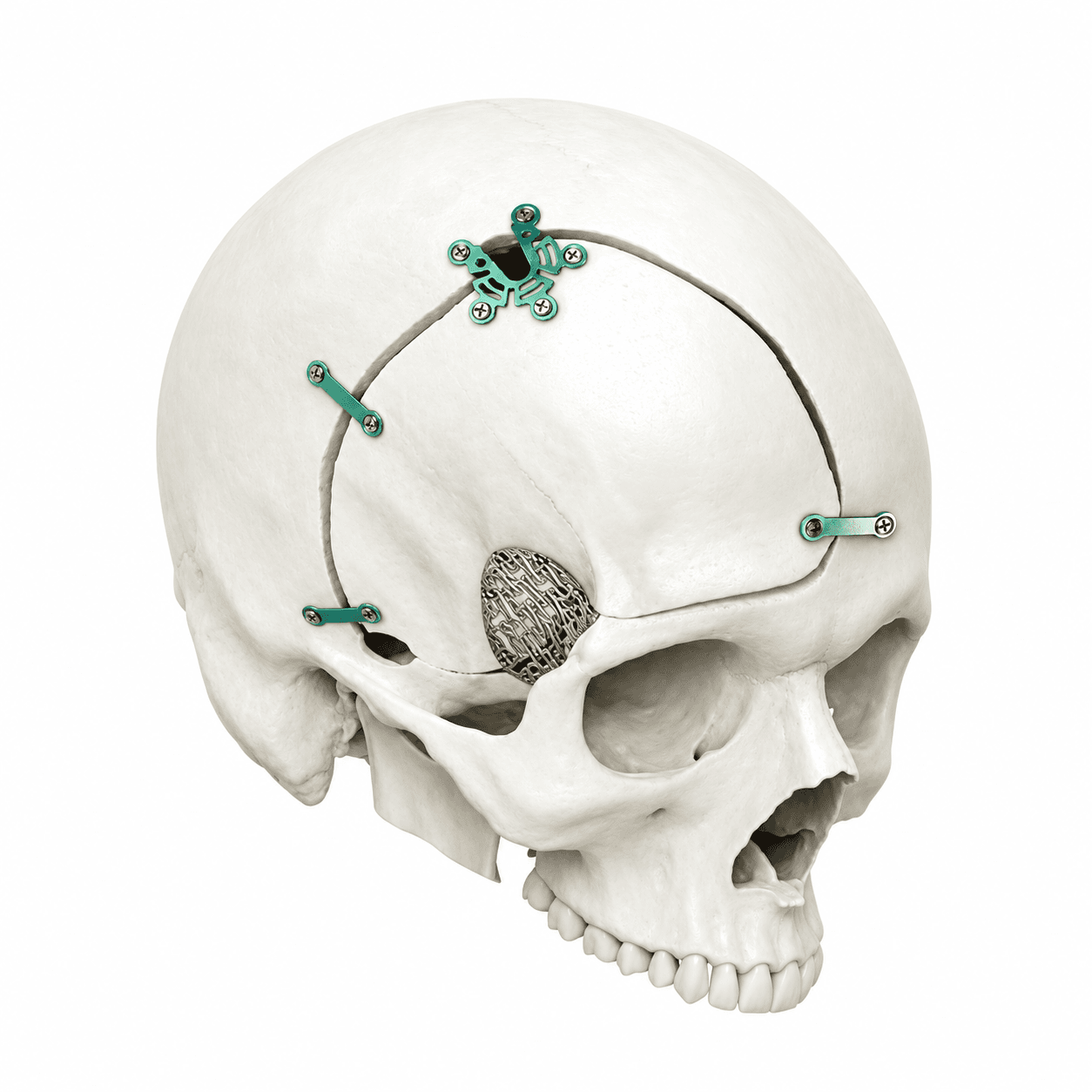 Placas e Parafusos – Le Fort Neuro System