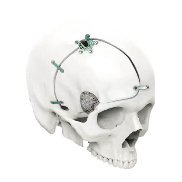 Placas e Parafusos – Le Fort Neuro System